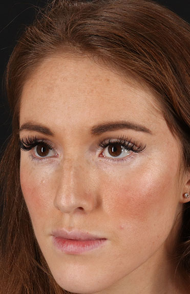 Before - left_oblique