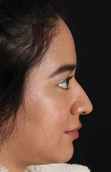 Before - right_lateral