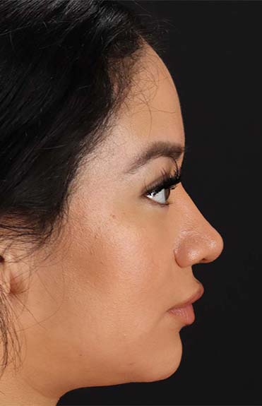 After - right_lateral