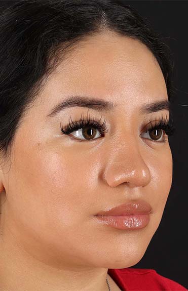 After - right_oblique