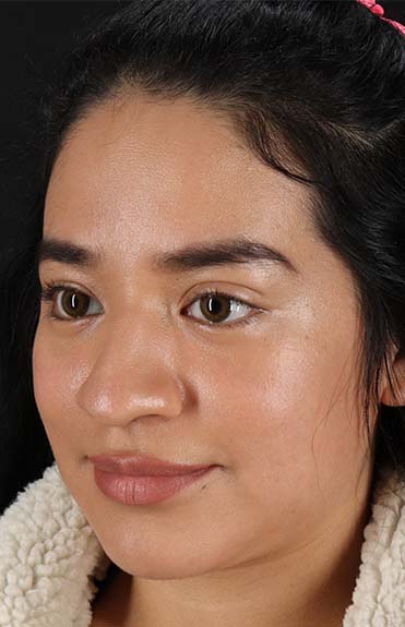 Before - left_oblique