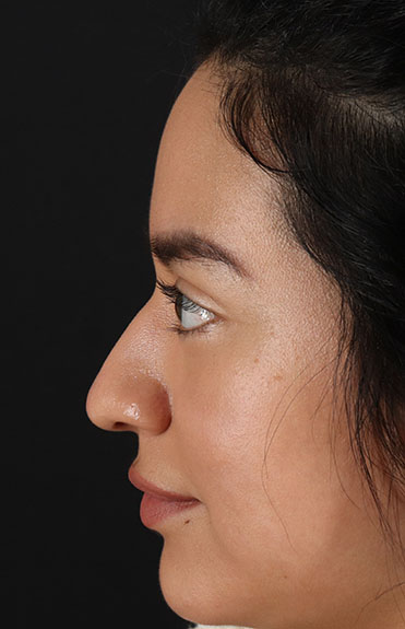 Before - left_lateral