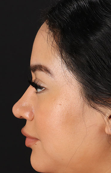 After - left_lateral