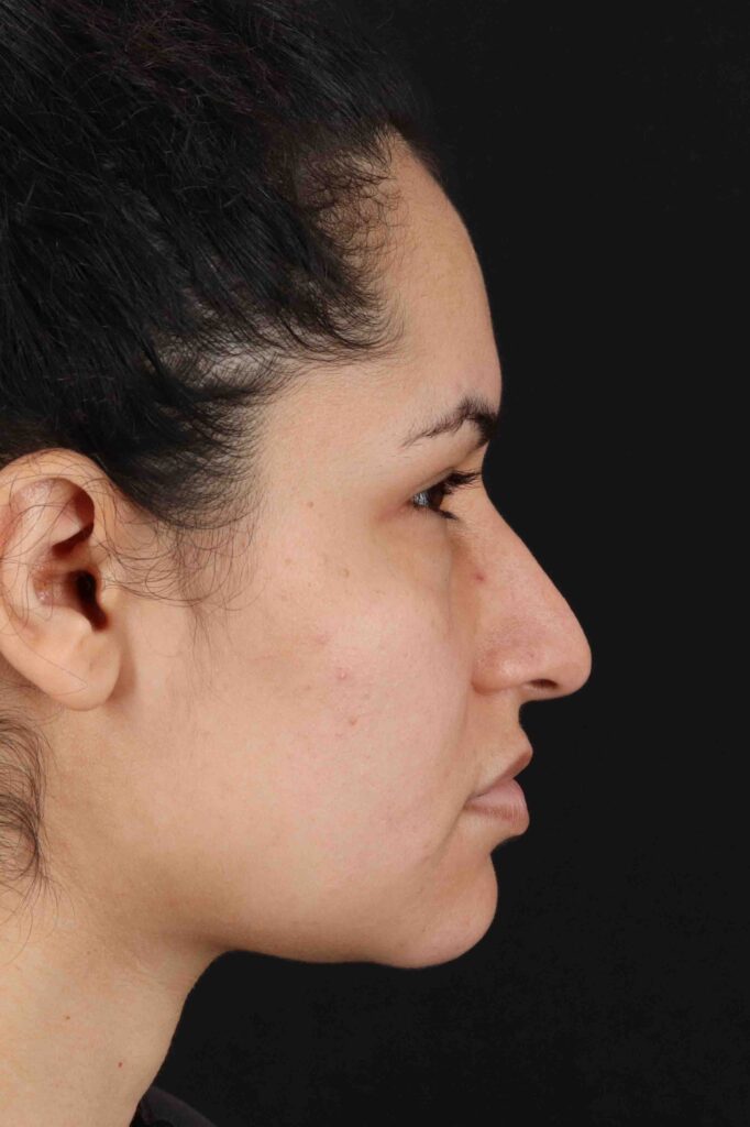 Before - right_lateral