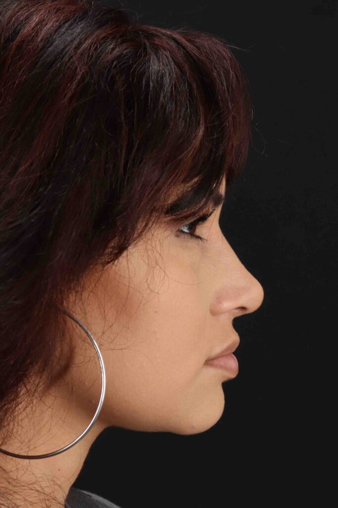 After - right_lateral