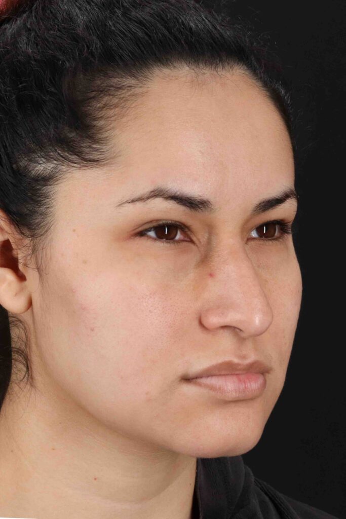 Before - right_oblique