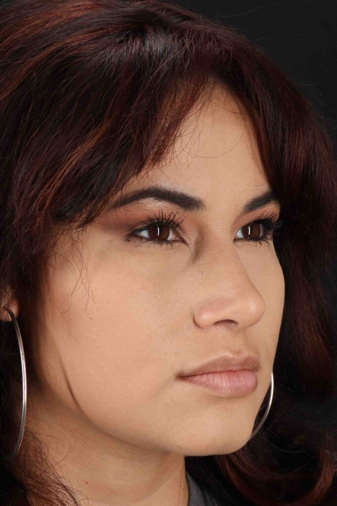 After - right_oblique