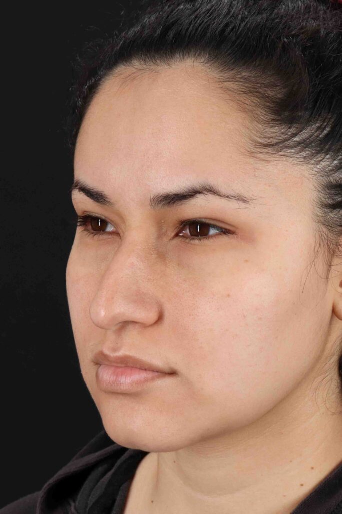 Before - left_oblique