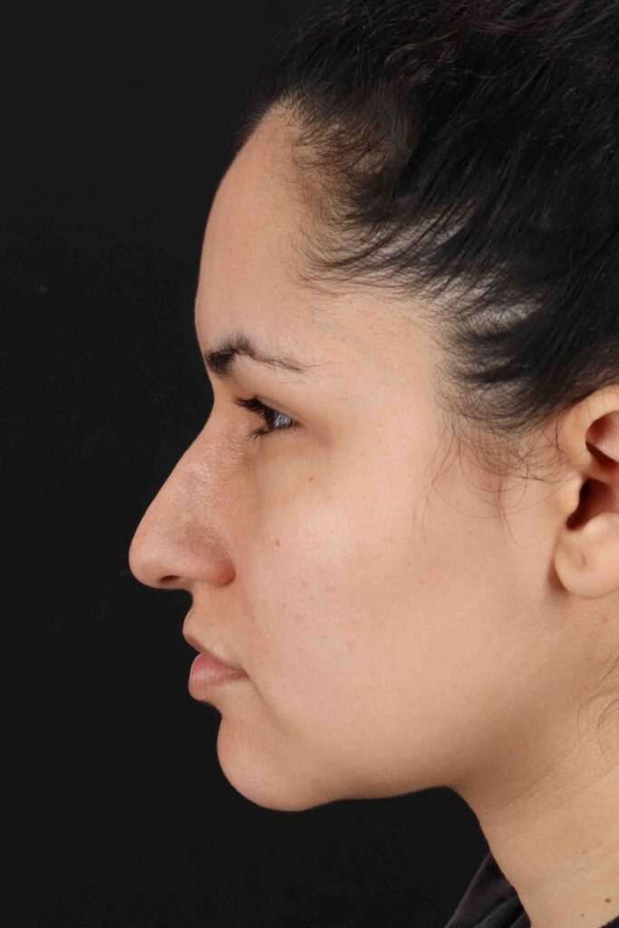 Before - left_lateral