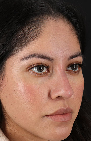 After - right_oblique