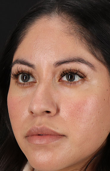 Before - left_oblique