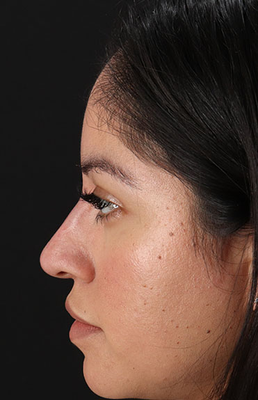 After - left_lateral