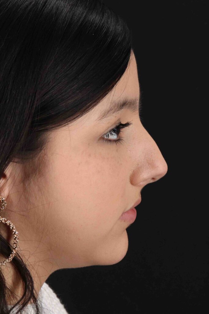 Before - right_lateral