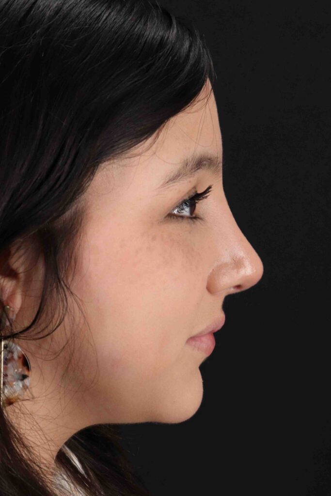 After - right_lateral