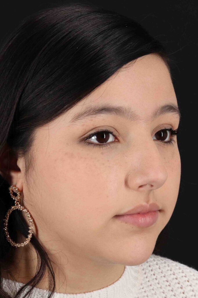 Before - right_oblique