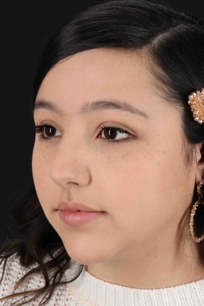 Before - left_oblique