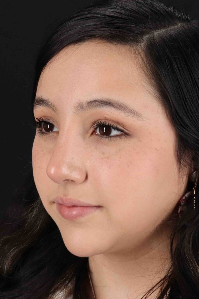 After - left_oblique