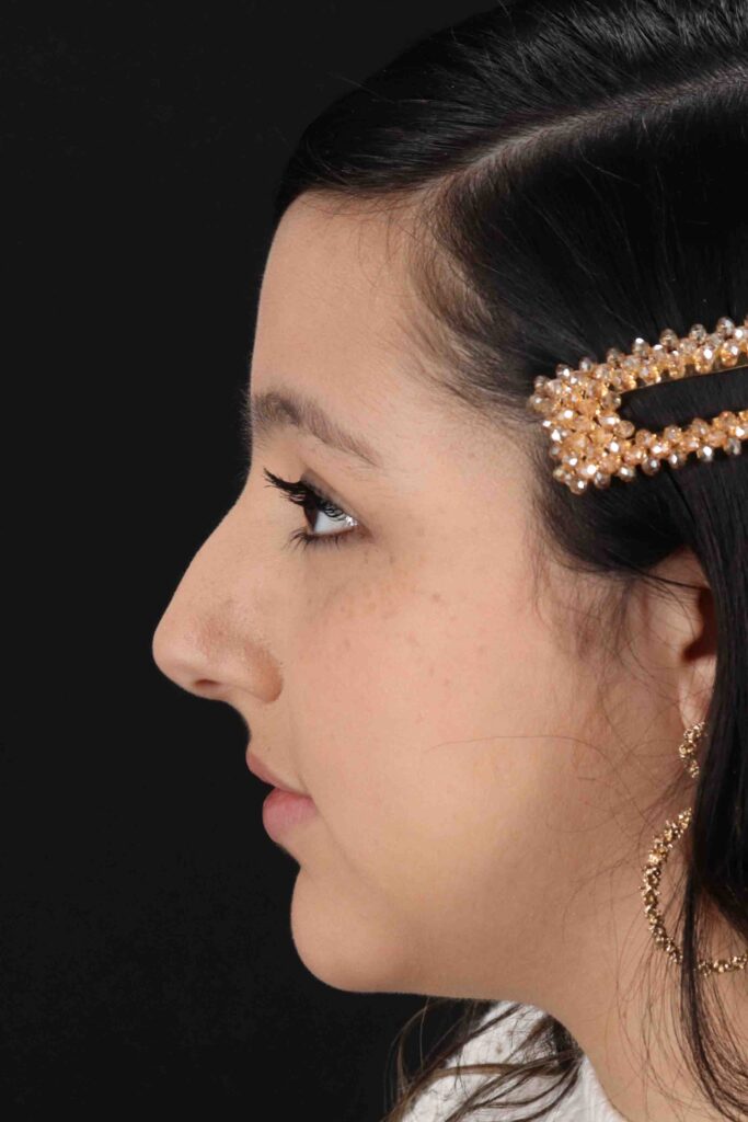 Before - left_lateral