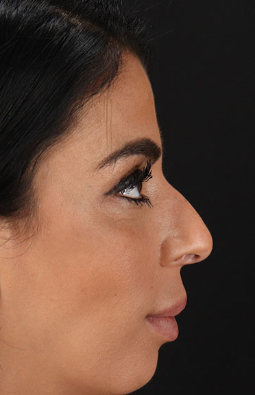 Before - right_lateral