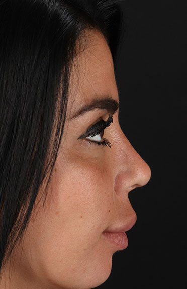 After - right_lateral