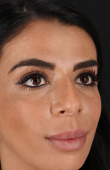 Before - right_oblique