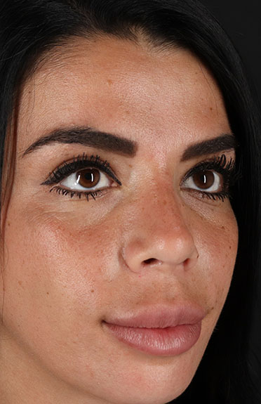 After - right_oblique