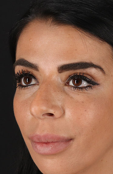 Before - left_oblique