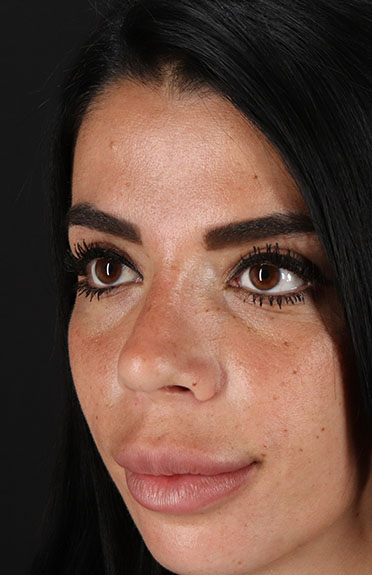 After - left_oblique