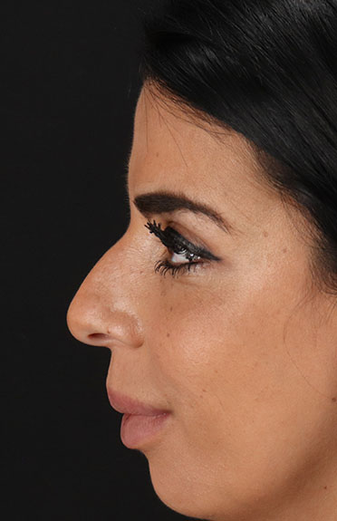 Before - left_lateral