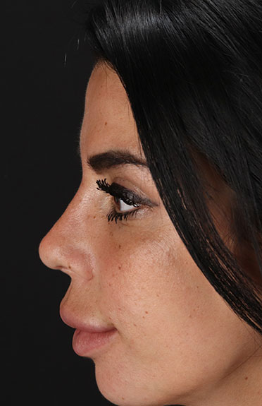 After - left_lateral