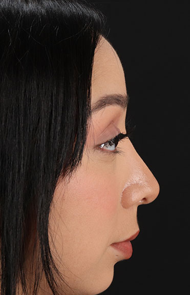 After - right_lateral