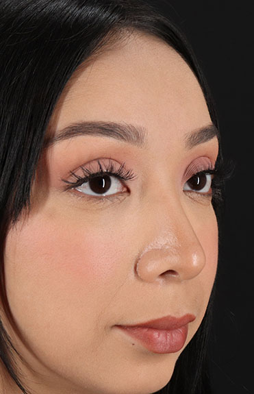 After - right_oblique