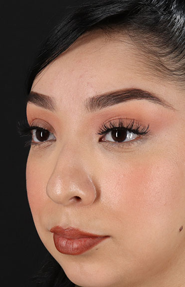 Before - left_oblique