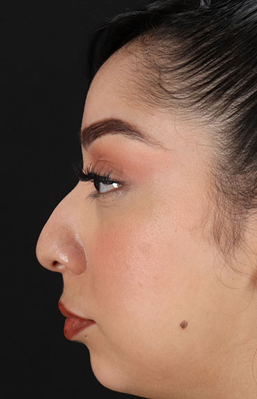 Before - left_lateral