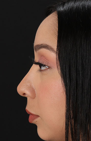 After - left_lateral