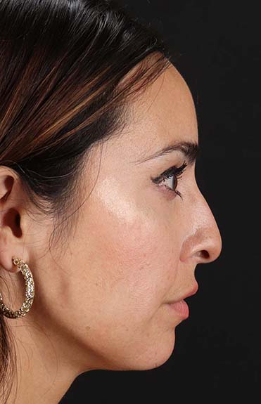 Before - right_lateral