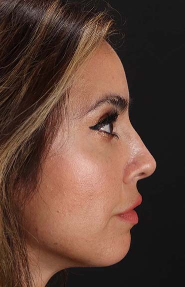 After - right_lateral