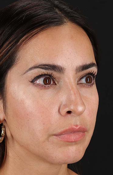 Before - right_oblique