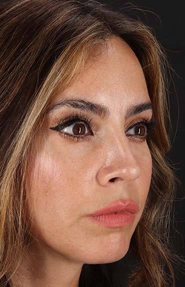 After - right_oblique