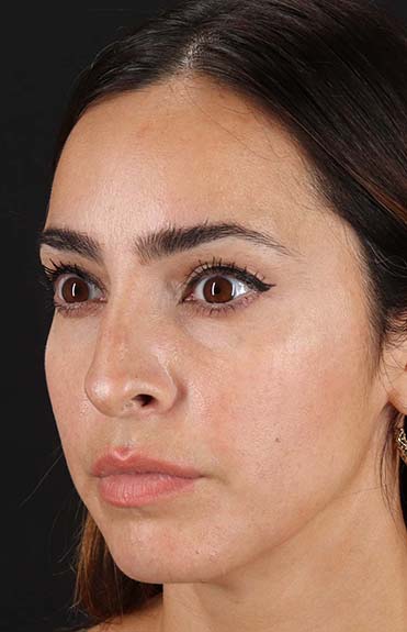 Before - left_oblique