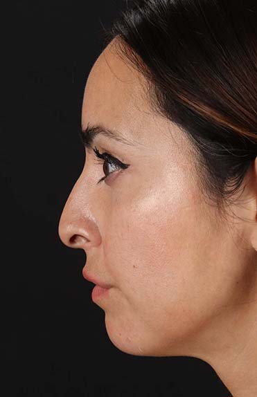 Before - left_lateral