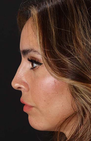 After - left_lateral