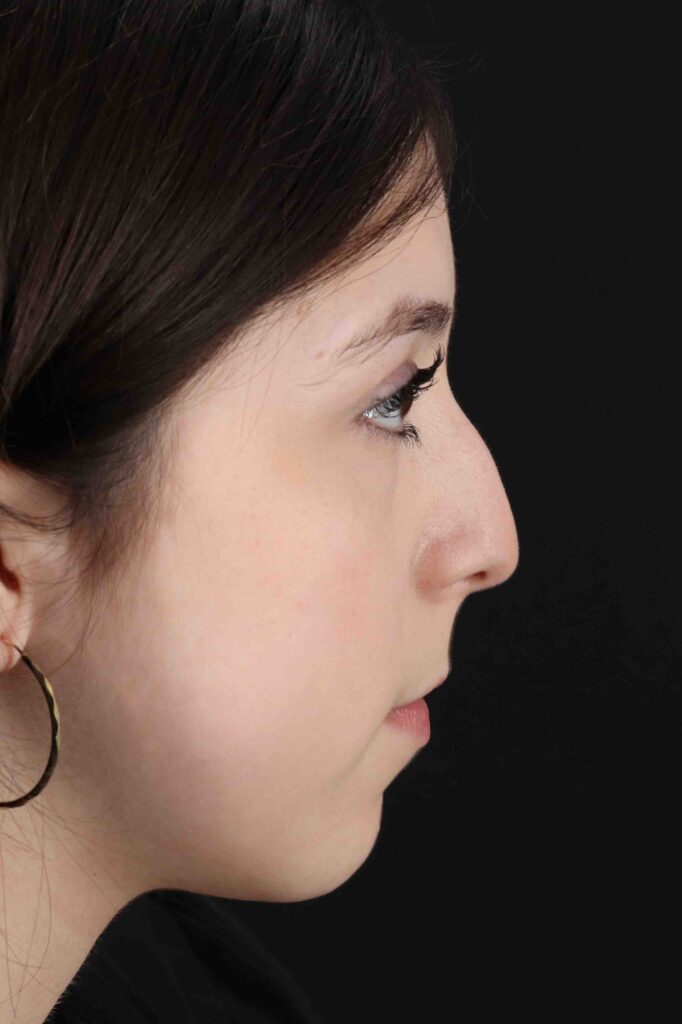 Before - right_lateral