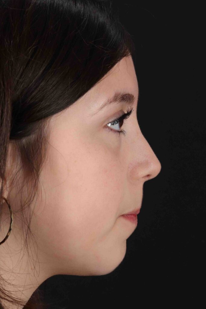 After - right_lateral