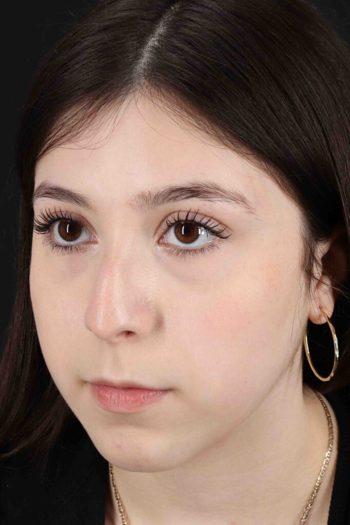 Before - left_oblique