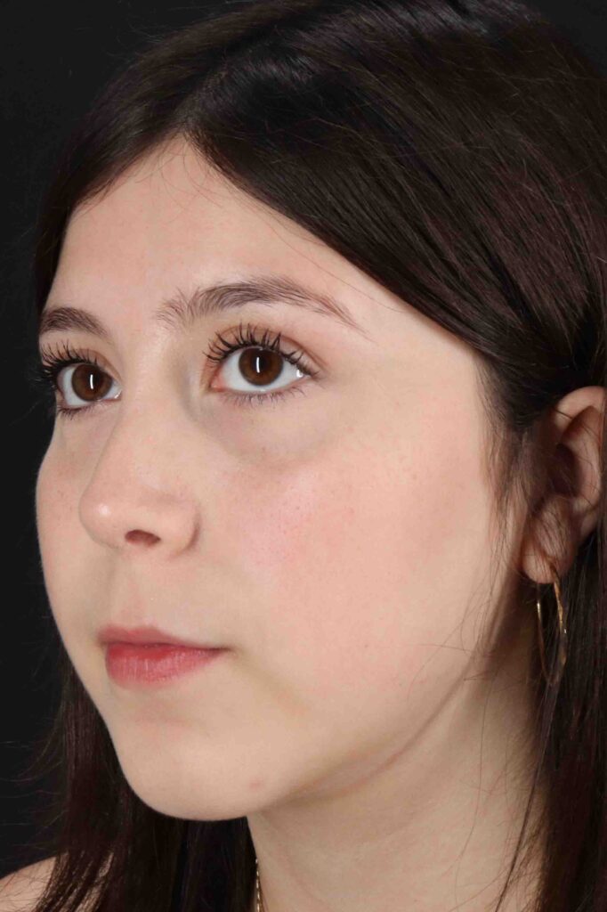 After - left_oblique