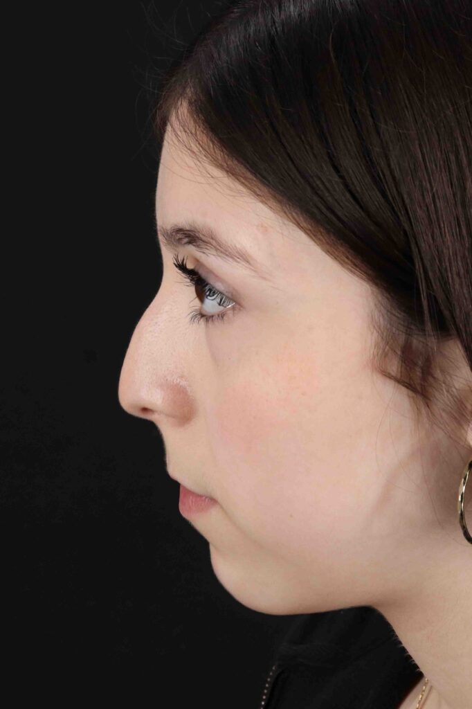 Before - left_lateral