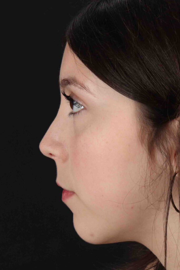 After - left_lateral