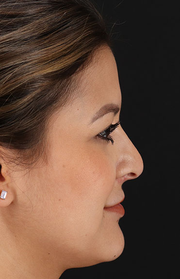 Before - right_lateral