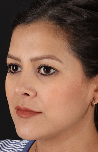 After - left_oblique